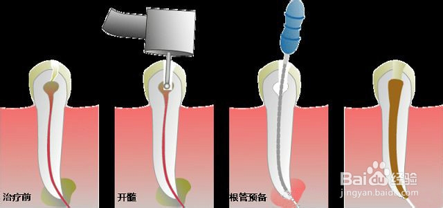 有蛀牙怎么办修补蛀牙什么是根管治疗