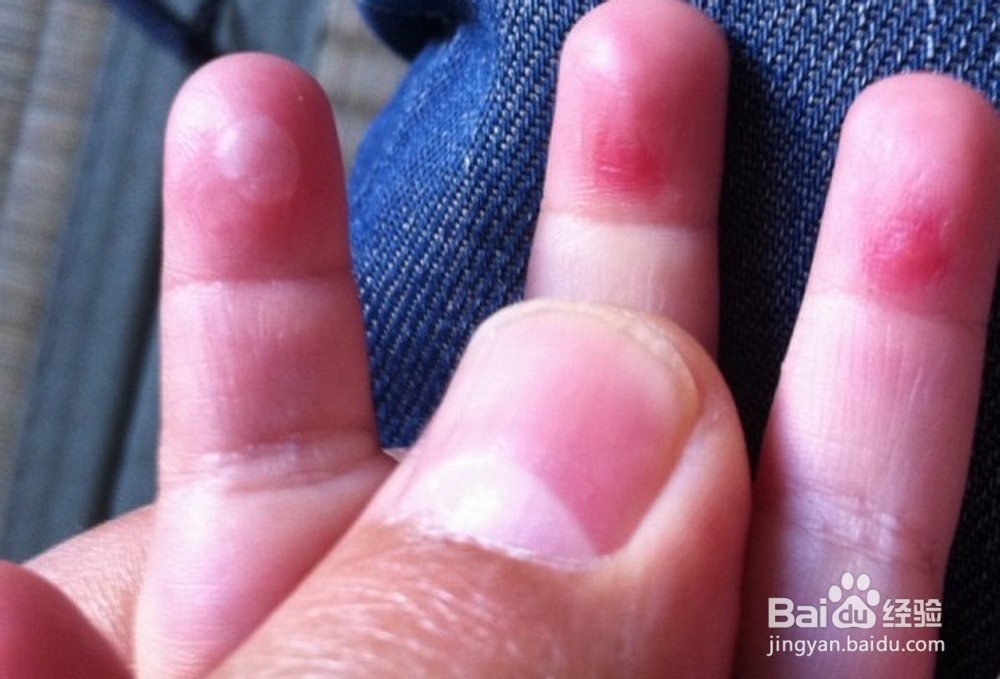 幼儿烧伤烫伤怎么办? 幼儿烧伤烫伤预防处理方法