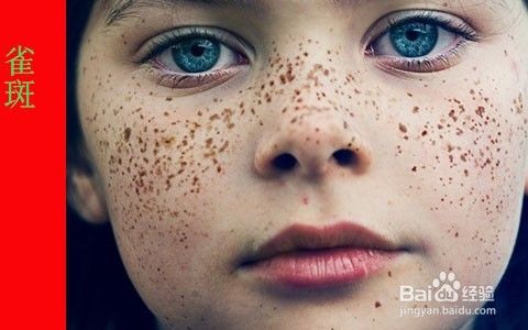 点斑水能祛斑吗 药水点能去掉雀斑吗 百度经验