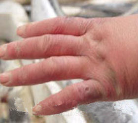 怎样适时防治冻疮？