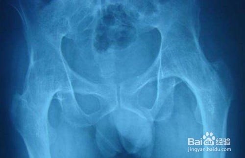 强直脊柱炎怎么锻炼