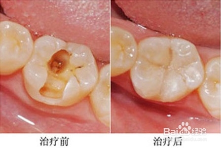 为什么牙齿要做根管治疗？根管治疗的步骤