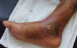 表皮暗红 由于有广泛的静脉努张或曲张以及毛细血管扩张,因此会出现