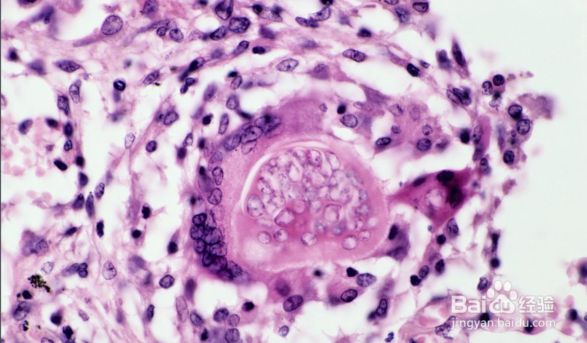 真菌孢子怎么杀死