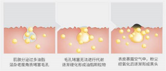 黑头仪有用吗？这些去黑头误区你别再踩了