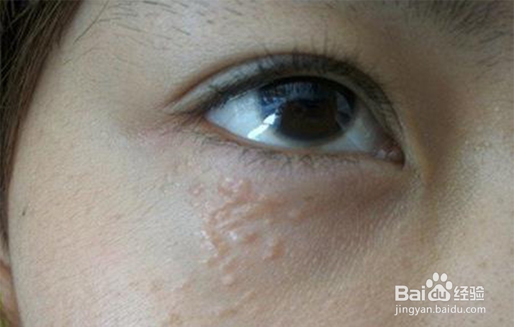 怎样去除眼部脂肪粒?