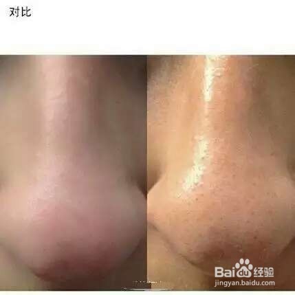 去除黑头草莓鼻