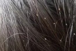 几种去掉虱子的好办法