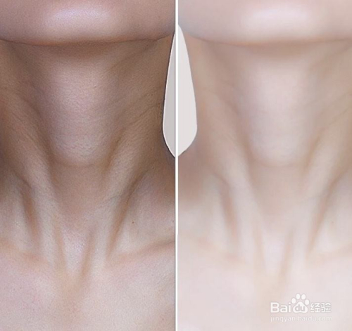 去颈纹鸡皮疙瘩怎么办(蛇皮纹鸡皮疙瘩怎么去除) 去颈纹鸡皮疙瘩怎么办(蛇皮纹鸡皮疙瘩怎么去除)