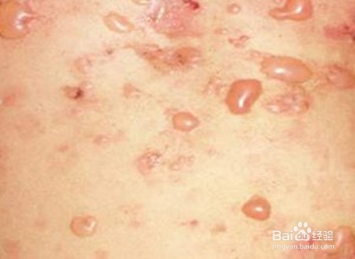 糖尿有哪些并发症