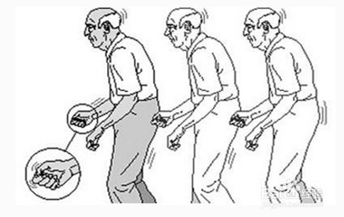 特发性震颤的康复病例