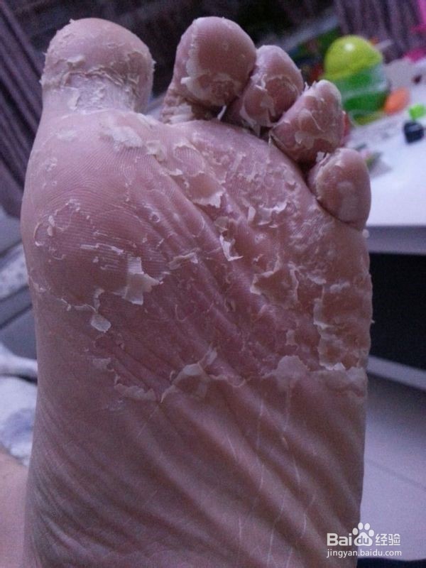 生活中如何治脚气