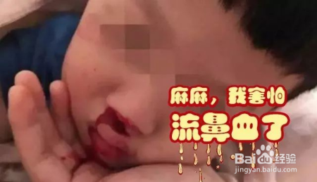 孩子流鼻血该送医院不？着急止血却总是做错的爸妈看过来！