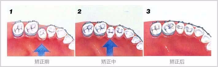牙齿矫正时应注意什么