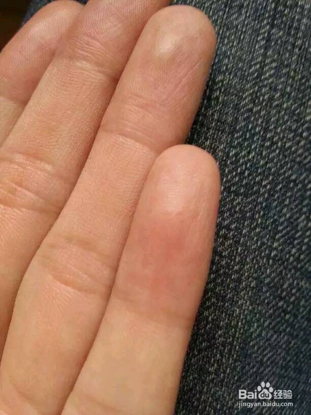 冬天手总脱皮怎么办