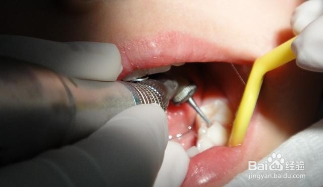 合肥补牙多少钱一颗