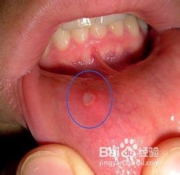 出现口腔溃疡怎么办