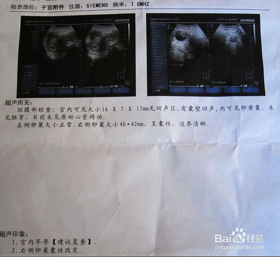 如何快速检查是不是怀孕了？