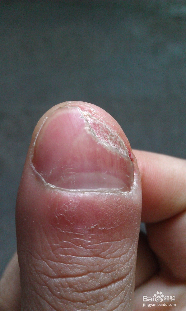 最常见的四种灰指甲治疗方法免费分享