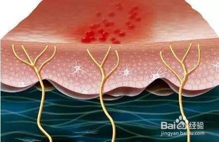带状疱疹疫苗有必要接种吗?