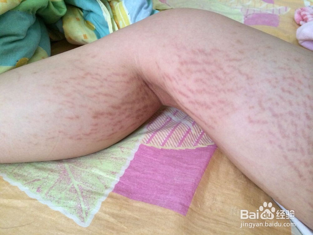 妊娠纹如何去掉