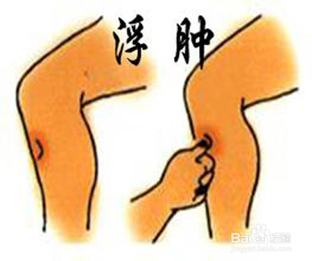 拔罐祛湿吗,拔罐祛湿效果好吗？