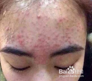 这几个特征说明你体内湿热较重