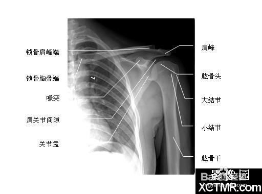 零基础教你认识肩关节X光片