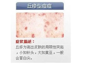 世上最全面治疗痘痘大全