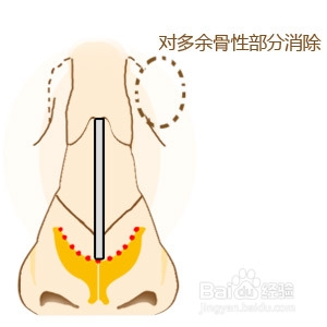 特异鼻综合整形