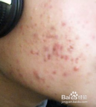 脸上起红疙瘩