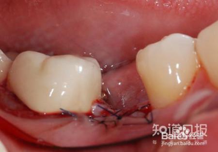 种植牙真的有那么好吗?