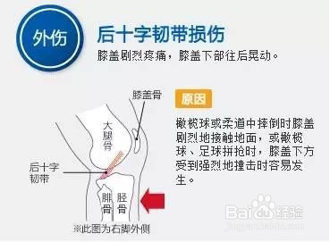 【运动课堂一】膝盖的损伤和预防