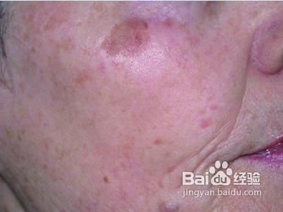 纯天然祛斑方法