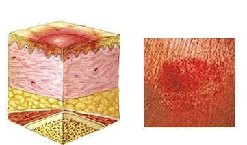 褥疮最早初期图片