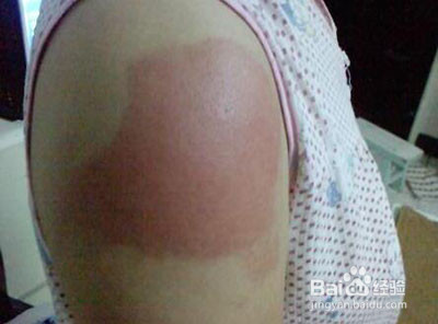 核桃树上虫子蛰了怎么办