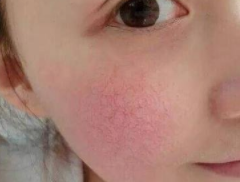 如何去除红血丝