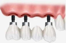 种牙后注意事项