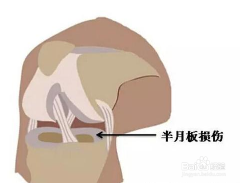 半月板损伤的症状及治疗方法