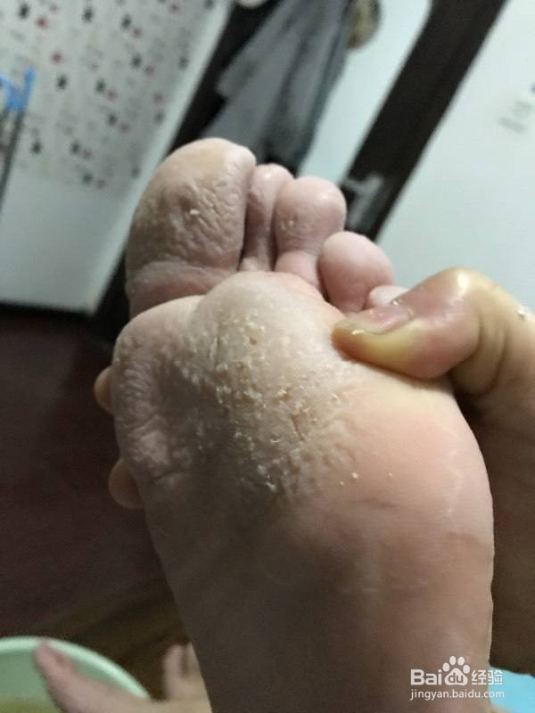 脚上起水泡很痒怎么办？