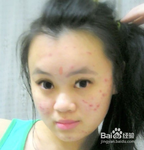 去角质哪些人要慎重