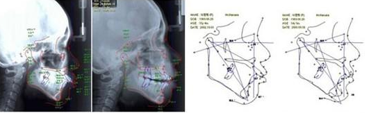 骨性地包天该怎么治疗