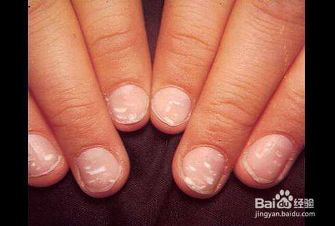 教你怎么治灰指甲