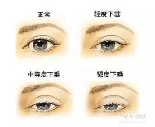 固元提肌汤治疗重症肌无力效果怎么样