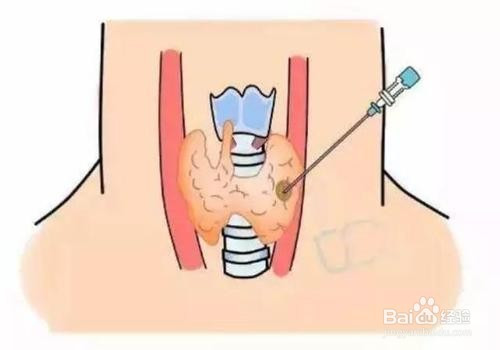 甲狀腺結節的檢查項目有哪些?