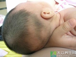 宝宝出现枕秃是怎么回事