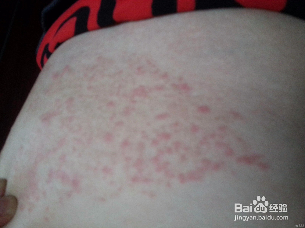 皮肤瘙痒起红疙瘩,怎么办?