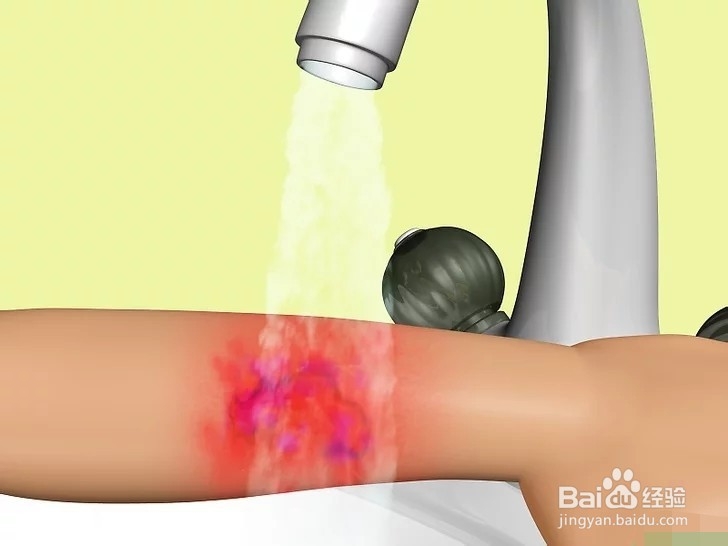 如何治疗烧伤？