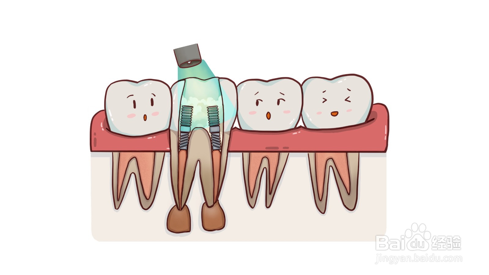 什么是根管治疗？有什么危害？