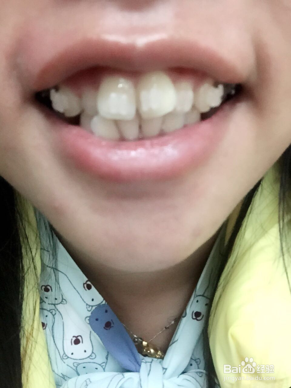牙套妹正式戴牙套的懵懂